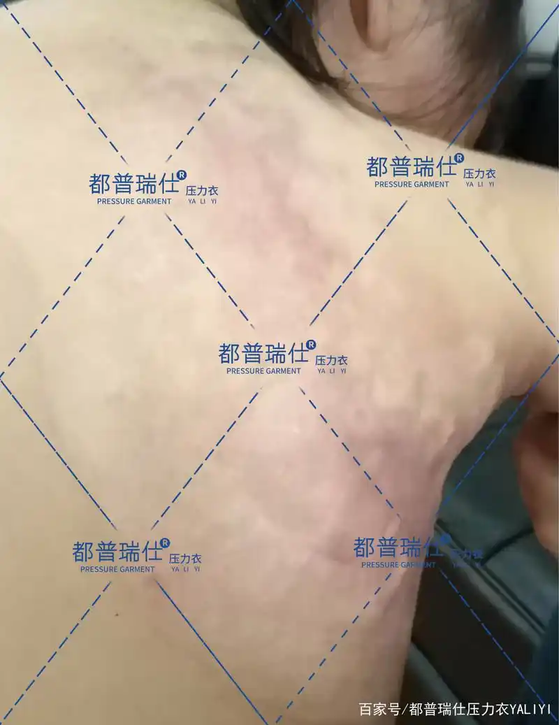 都普瑞仕:儿童增生性瘢痕该怎么处理