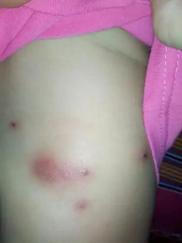 宝宝屁股长胧包.求有经历宝妈