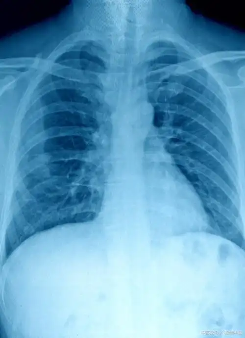 《肺癌科普百问》16,胸片,胸透能起到早期筛查肺癌的作用吗?