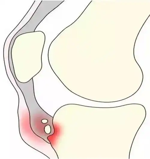胫骨结节骨软骨病