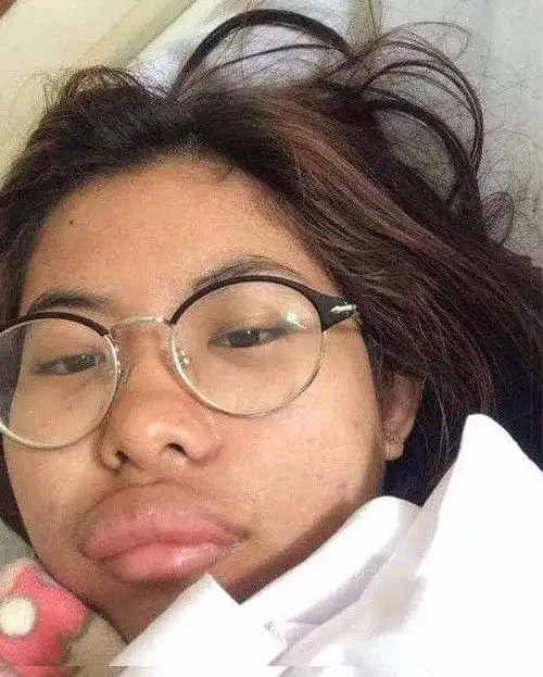 女子深夜骑行沾染此物,第二天长出香肠嘴,都不用整容了