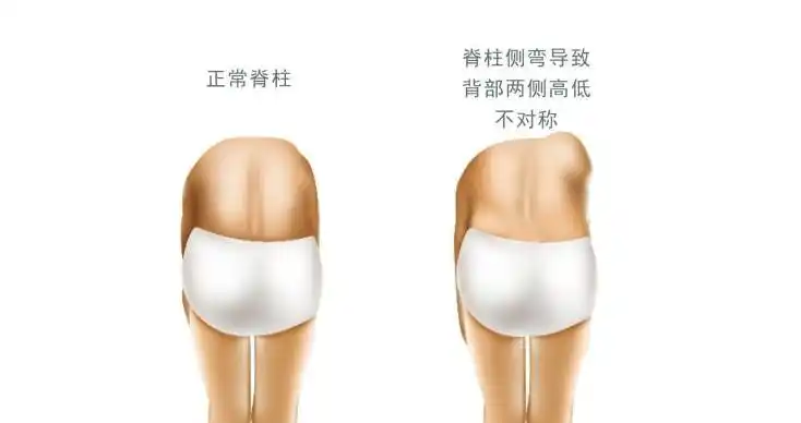 剃刀背成青少年脊椎发育克星如何自查