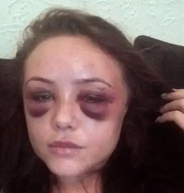 女子只因一条短信, 被丈夫打成鼻青脸肿, 短信内容只有6个字!