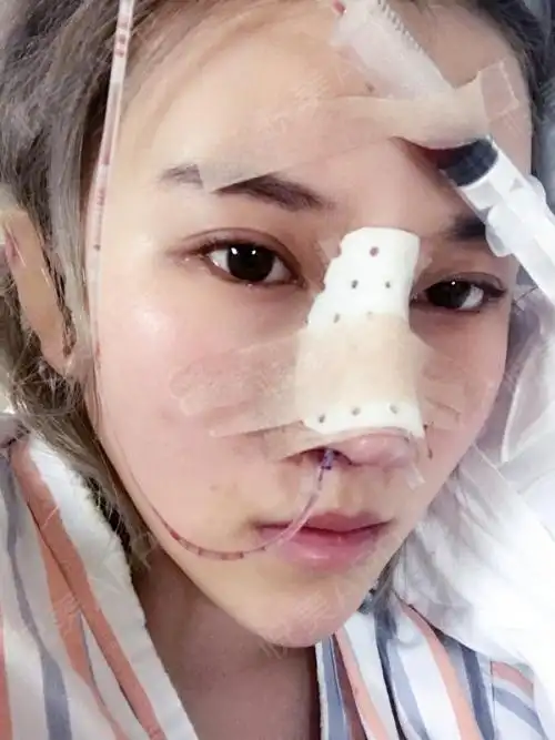 上海伊莱美膨体隆鼻第三天刚做完手术,睡了好久,做的.鼻综合_悦美整形