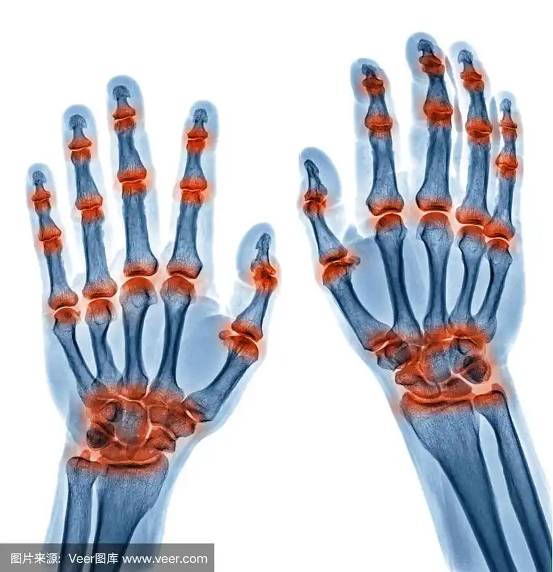 由痛风性关节炎引起的双手多关节炎症的x线图像,类