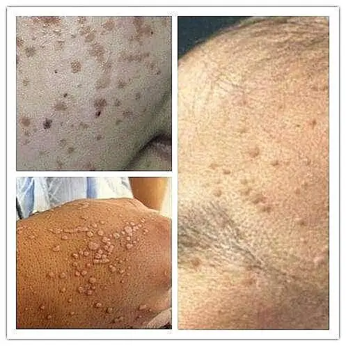 扁平疣,不是那么容易看好的病? - 好大夫在线