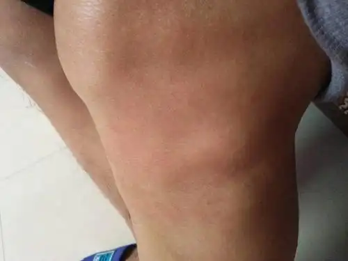 膝关节长期疼痛,外侧骨头还长了个包,请问是怎么回事?专业人事回答!