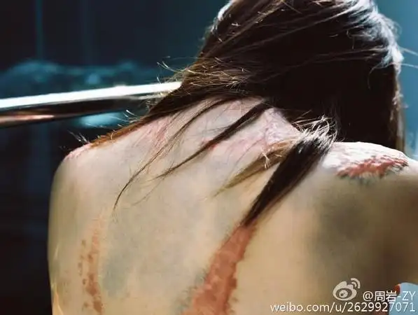 当年16岁的她惨遭「泼油毁容」,如今5年后的她决定