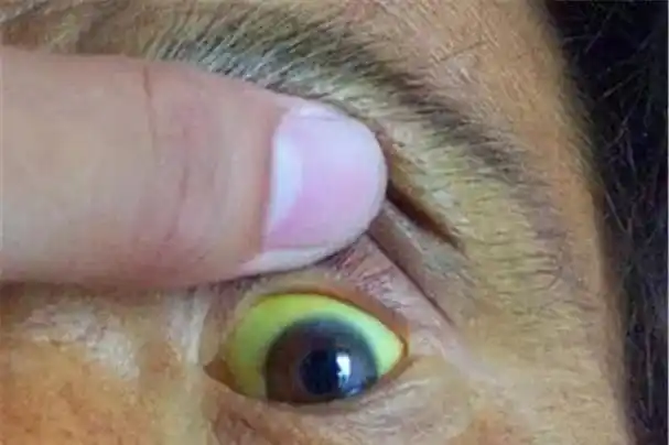 肝病不痛不痒,可当面部出现这5个体征时,说明你的肝正在坏掉!