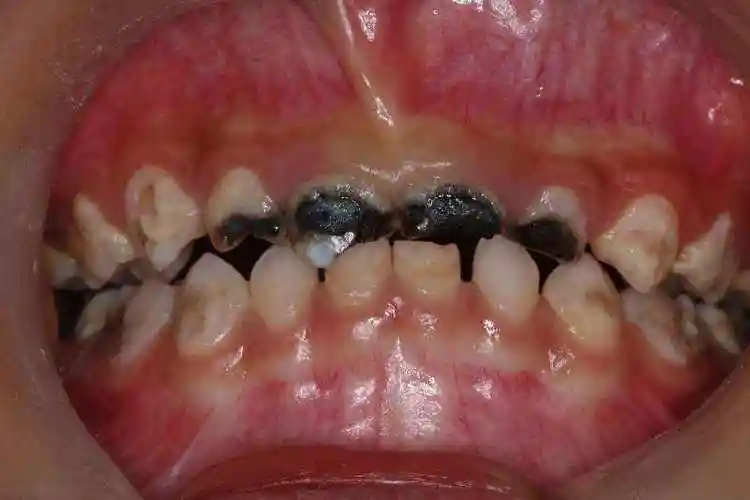 3岁娃一口牙烂16颗只因这个坏习惯