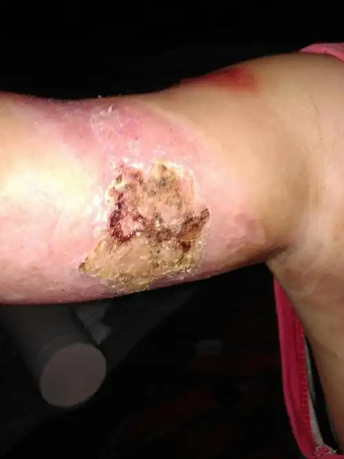 烫伤一个多月了,结痂了,很干 怎样快点把迦去掉