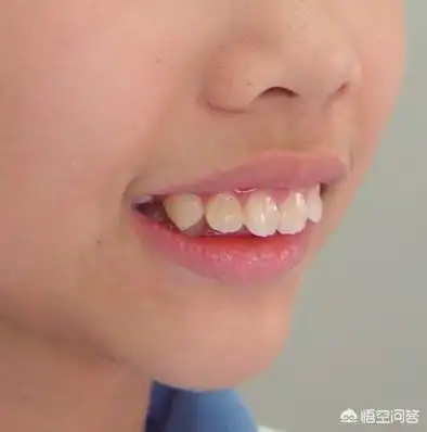 头条问答 - 牙齿咬合畸形能吹萨克斯吗?(3个回答)