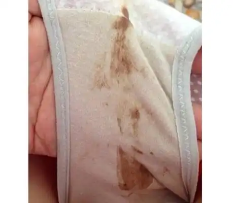 白带带血图片49