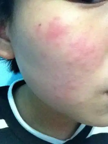 春季脸部皮肤过敏红痒怎么办脸部皮肤过敏红痒用什么药膏