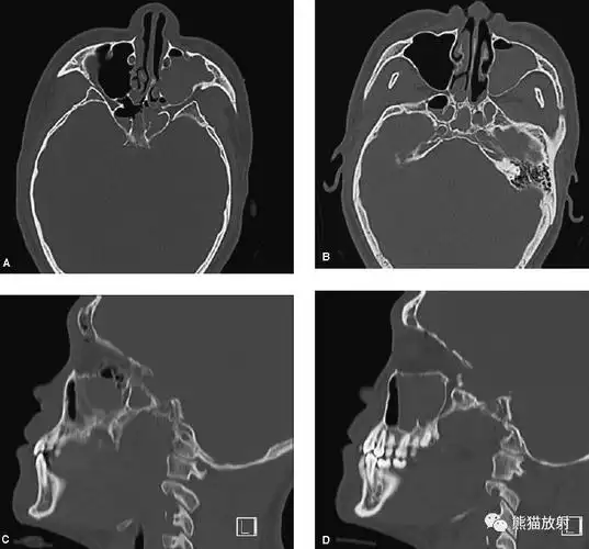【急诊】颧骨骨折,上颌骨骨折ct表现