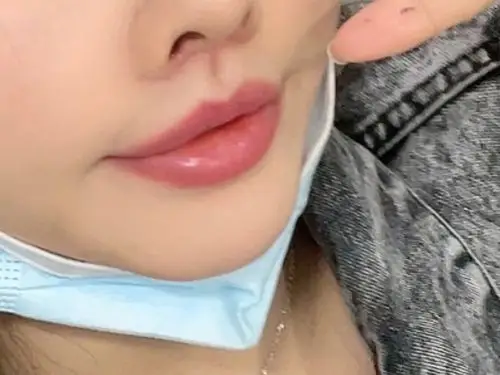 人中缩短第10天了,恢复的会有点慢,感觉上嘴唇厚了_圈子-新氧美容整形