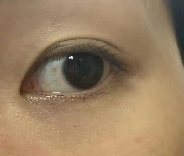 眼球红血丝