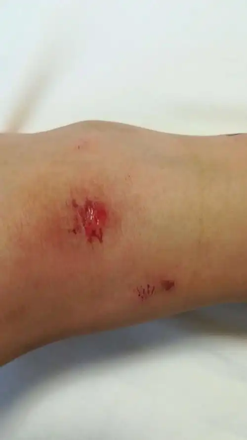 7月25日～～滑板的创伤