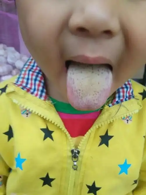 脾胃不好的孩子从舌苔也是能够看得出来的,舌苔会比较厚腻或者是发白