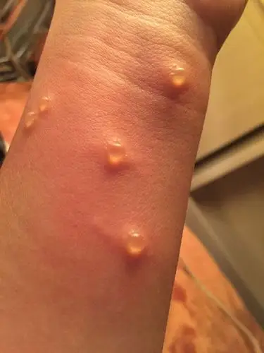 身上起了一些疙瘩,开始是小的红点,抓了后就变成这样硬的包包了,中间