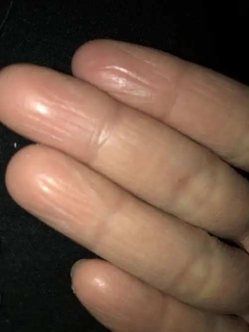 为什么我的手掌干裂成这样了