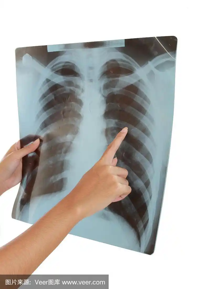 人体胸部x光片.