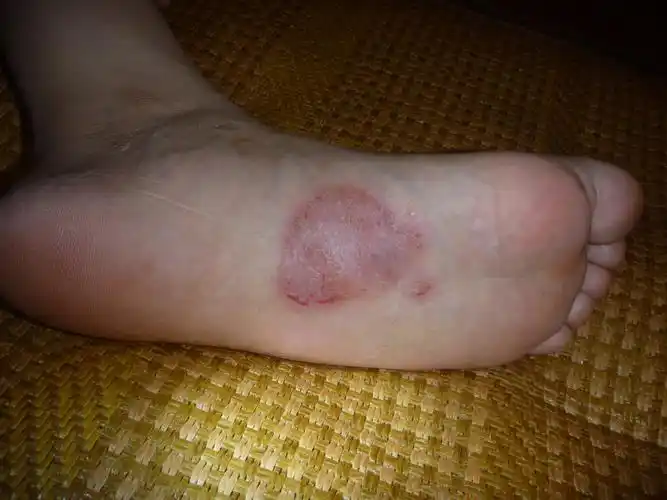 求助脚底皮肤破损发红时有淡黄色液体流出