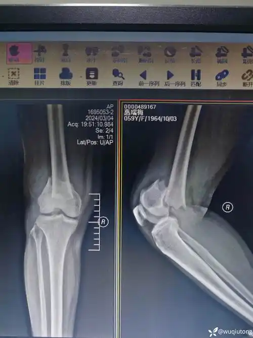 股骨髁上骨折股浅静脉损伤