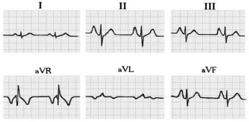 右心房肥大心电图