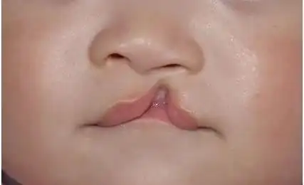 假如生了唇腭裂宝宝怎么办