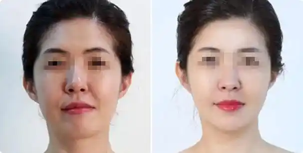 各种面部抗衰老项目的效果都比较过了,赶紧收藏吧. – 【剪辑之家】