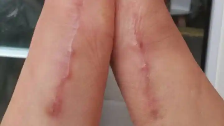 关于拇外翻术后伤口问题