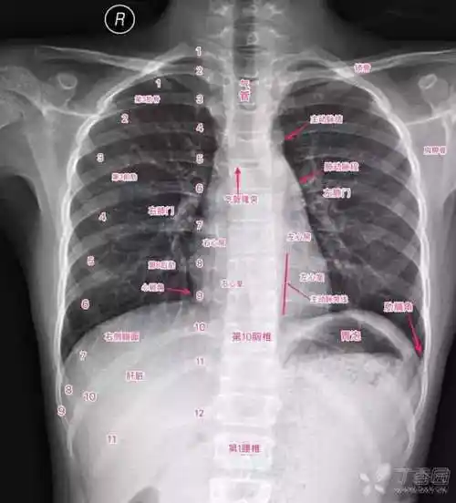 诊断气胸,按照我个人的读片步骤:患者信息>肺透过度>气管纵隔>心脏大