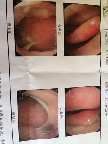 我现在这ct照片显示上颌窦囊肿需要手术吗?