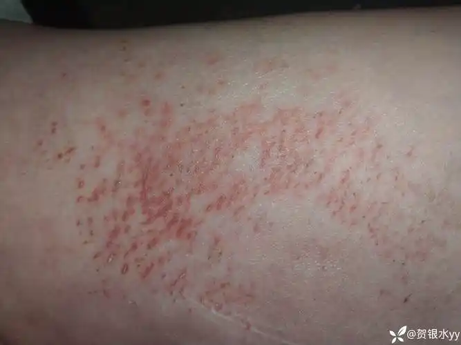 请问这是湿疹吗求解