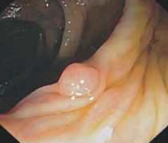 肛门息肉临床的图片_有来医生