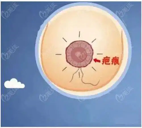 双环法乳房悬吊术