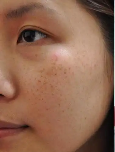 斑点显老,如何淡化斑点?