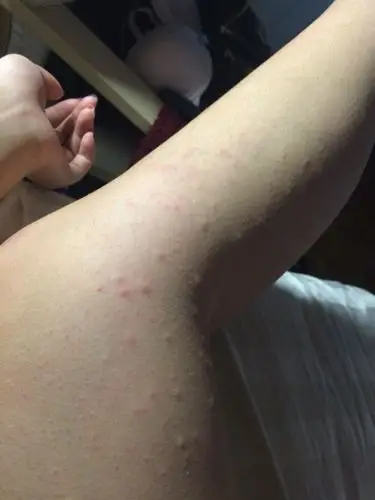 过敏了 第一二是刚发的时候 现在不痒了 变成第三张的小红点 以前就有