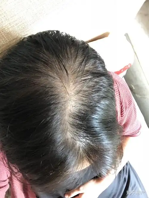 这样脱发还有救吗头发稀疏露头皮