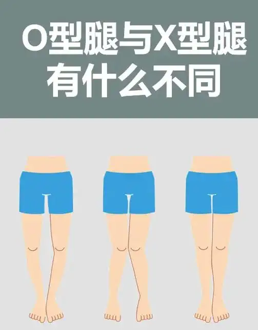 体态纠正 #o型腿 #抖音图文来了 #x型腿纠正  o型腿 - 抖音