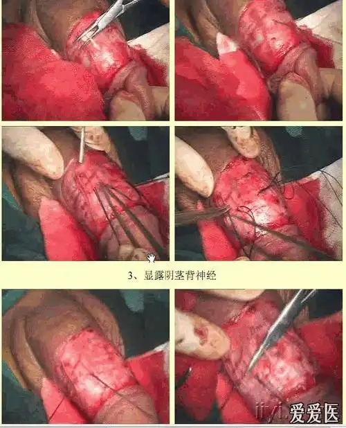 求阴茎背神经阻断术视频