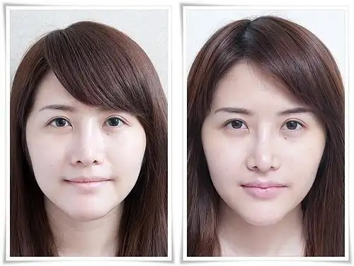 【玻尿酸丰唇前后对比图】 玻尿酸丰唇前后对比效果图_整形之家社区