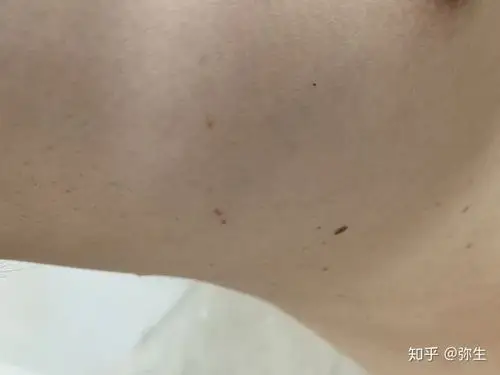 胸口长褐色斑点请问一下是什么东西什么原因造成已看医生统一回复