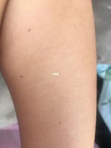 谁能告诉我我手臂上越来越多的小红痣是什么,害怕极了