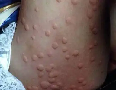 如果有上万只蚊子咬你你是什么感受我们看看下面这位