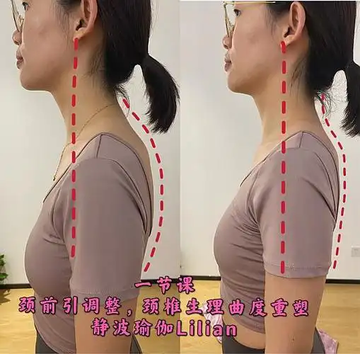 颈椎的生理曲度重塑十分钟对比1,直角肩五分钟左右对比,十分钟前后