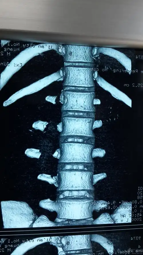 多发腰椎横突骨折一例,需要手术吗