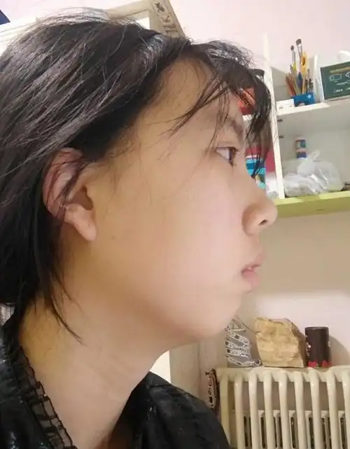 给大家看看严重的凸嘴下巴后缩