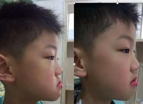 小孩儿骨性地包天要不要做矫正小孩儿骨性地包天矫正方法